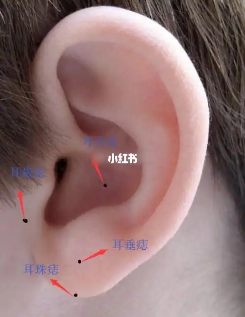 [思考]1,耳根有痣:害病在耳根位置出现痣的人需要注意身体上的健康
