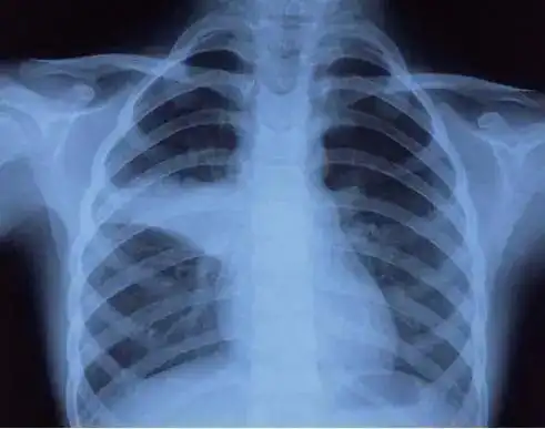 肺炎支原体来势汹汹,儿科专家支招如何防范