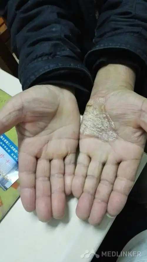 近20年来,患者无明显诱因而出现手掌足底皮肤出现角化皲裂,右手角化