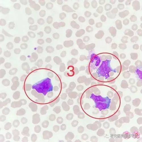 异型淋巴细胞图谱