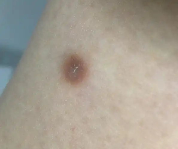 因为皮肤纤维瘤,对健康没有影响,而且也不会恶变.