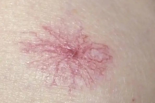 身上有很多小红点,像小红痣一样,不痛不痒是怎么回事?