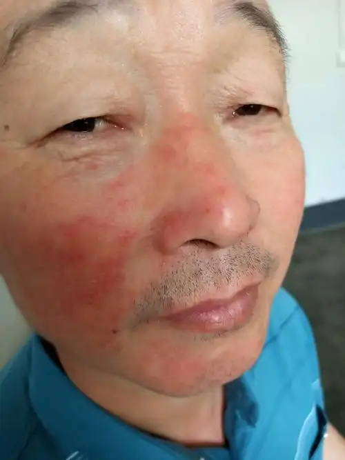 面部反复长红斑,是癣吗? - 皮肤及性传播疾病讨论版 - 爱爱医医学论坛