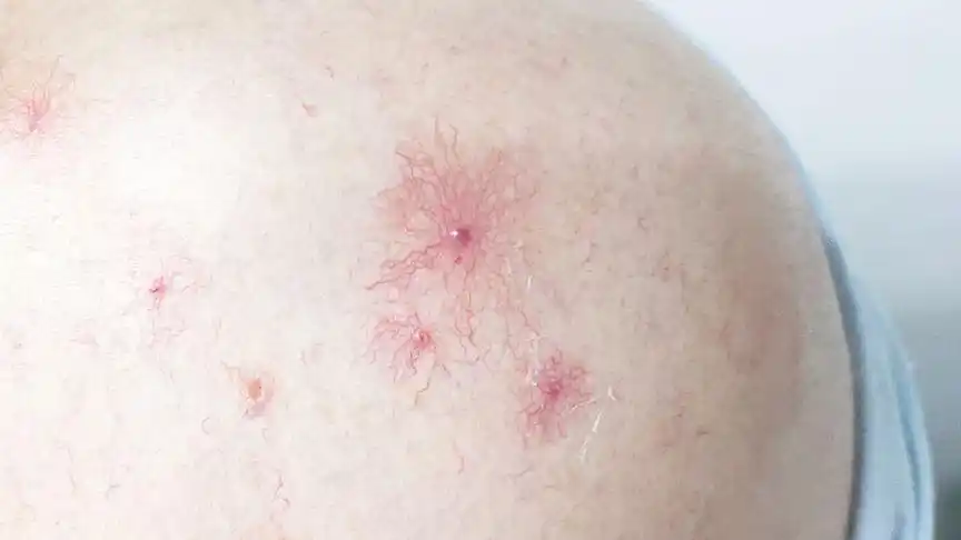 非常典型的蜘蛛痣,放射状,中间棉签按压之后,血管血供消退