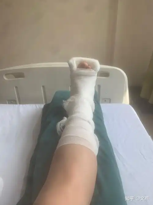 胫腓骨骨折,内外踝骨折的过程 - 知乎