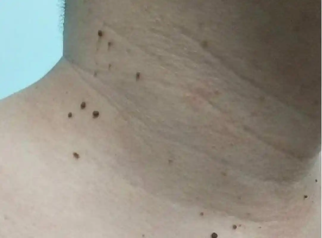 染hpv病毒脖子长"小肉疙瘩"#  近日,福州的陈女士不小心感染了hpv病毒