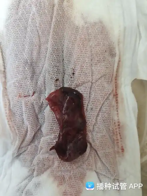 [试管婴儿]囊胚胚胎已经脱落了吗?唉22天