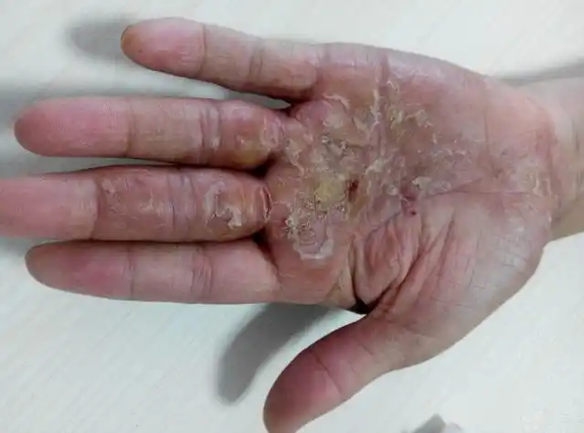 是否有足癣病史?手癣可能性大.