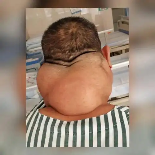 吓人中山一大爷每天喝1斤半白酒结果颈部长了比头粗的肿物重达2斤