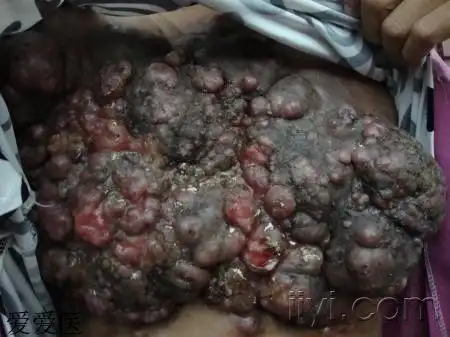 难得糊涂---乳腺癌皮肤转移