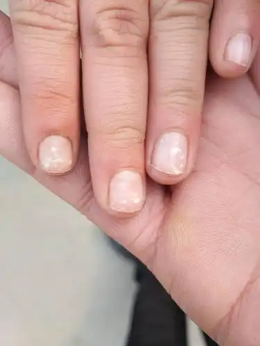 小孩指甲上好多白点,头发也化验了,微量元素也查了,还是有,这是怎