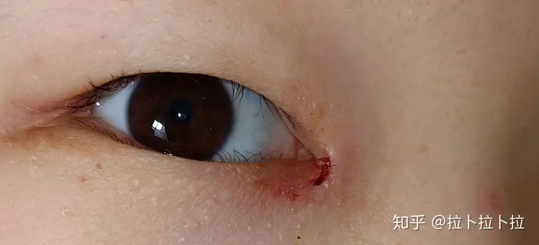 双眼皮拆线后眼角裂开怎么办