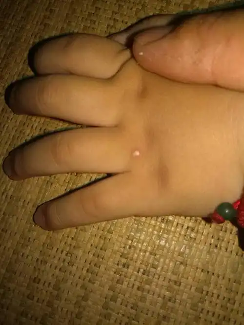 宝宝手上长了个痘痘 白色的小硬块 有朋友知道是什么吗?