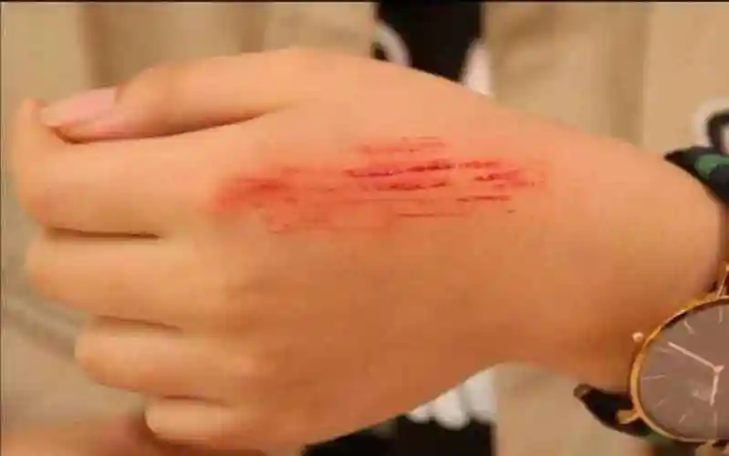 刀伤用什么药愈合最快伤口怎样愈合的快