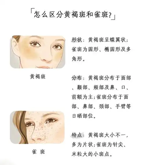 如何区别黄褐斑和雀_黄褐斑_美容仪_雀斑_抗氧化_中药调理_quasar md