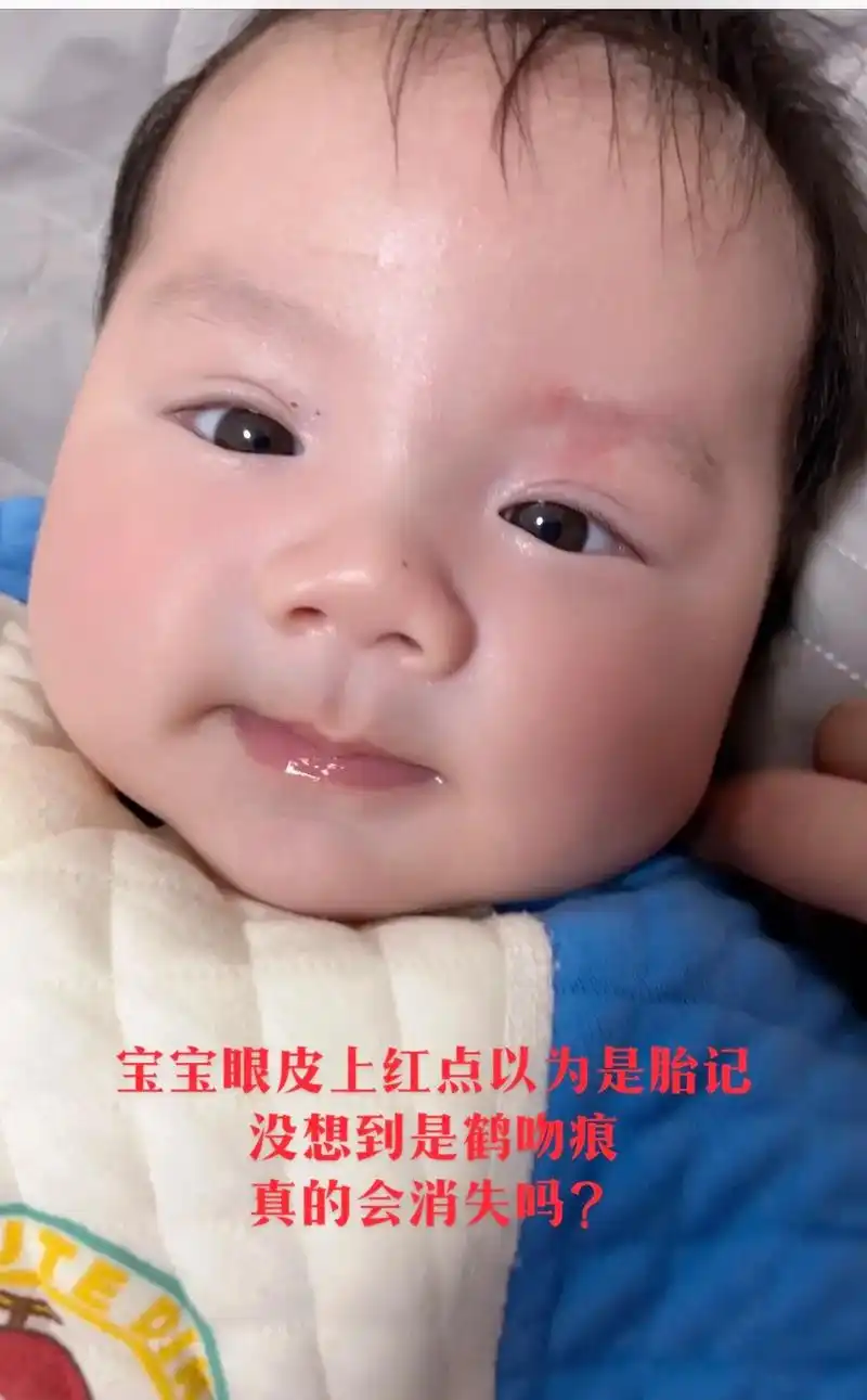 宝宝一出生眼皮上就有一块红色以为是胎记,后来才知道它有个好听 - 抖