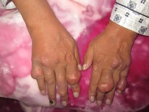 老人容易患有痛风图片