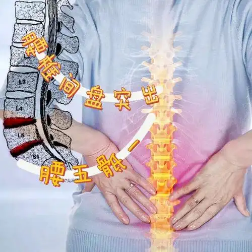腰椎间盘突出患者平日里做到这三点,能够有效改善,加快康复!