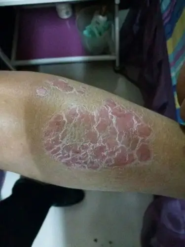 李海英老公牛皮癣好转过程