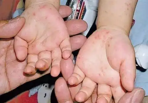 这种病毒出现新症状,近期进入感染高发季!一定要注意