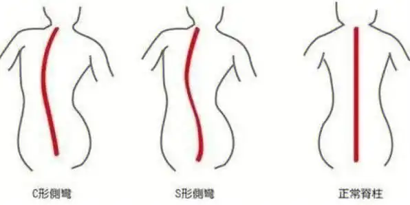 瑜伽理疗之脊柱侧弯