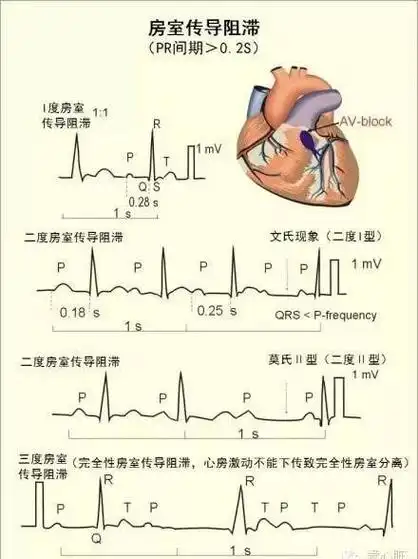 一个笑话教你轻松记忆心律失常心电图