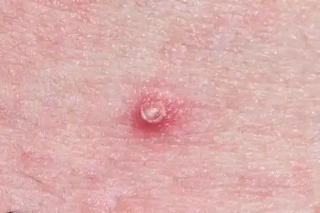 白头粉刺人类皮肤上的白头粉刺.照片