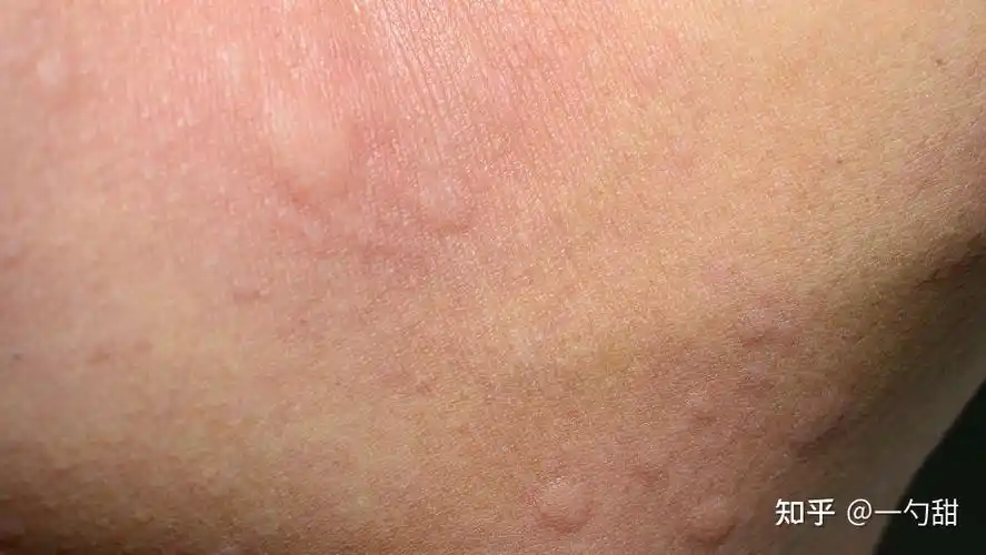 有什么止痒特别好的东西推荐