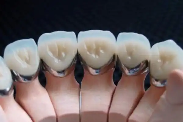 钴铬合金烤瓷牙