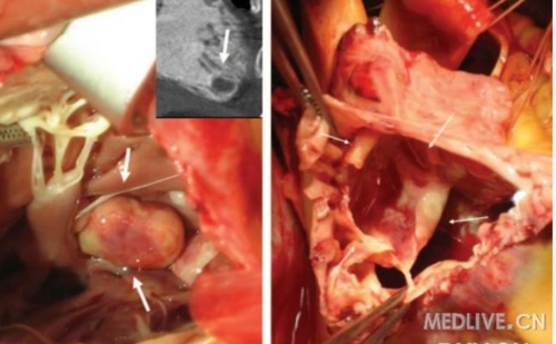 多点感染心内膜炎和右房室壁赘生物