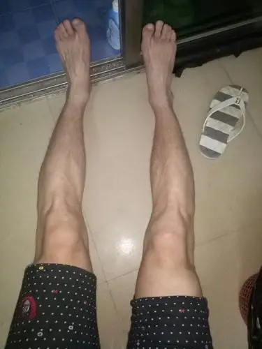 我这是o型腿吗?