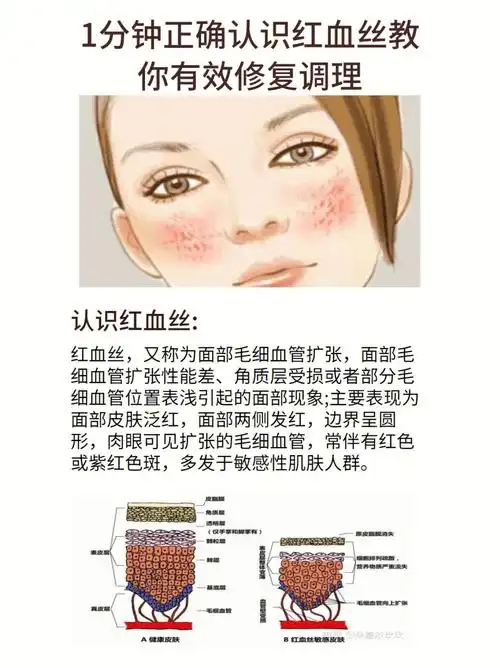 92一,认识红血丝:红血丝,又称为面部毛细血管扩张,面部毛细血管扩张