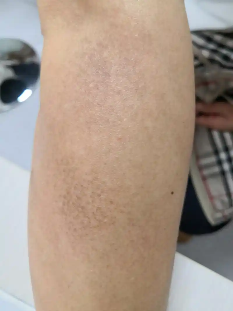 手臂黑褐色斑片.考虑色素沉着过度症状.活检排查一下诊断比较好.