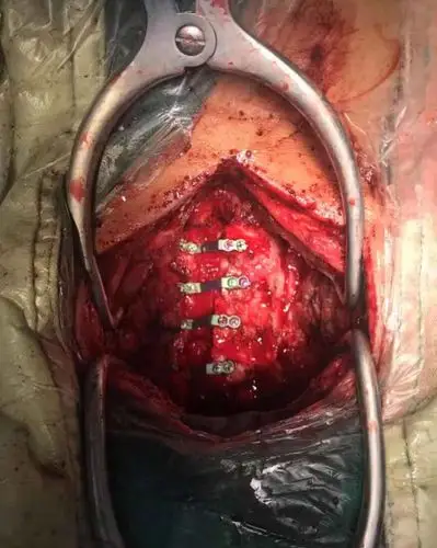 脊柱骨科再次完成一例颈椎后路单开门椎板减压手术