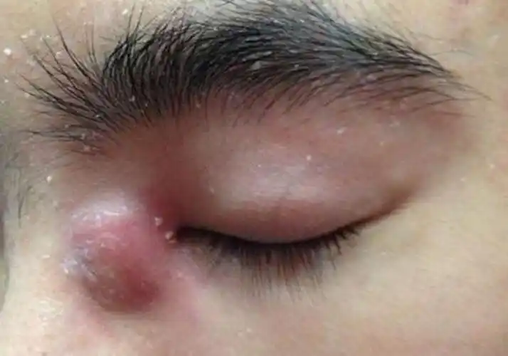 耳朵后边的皮脂腺囊肿图片