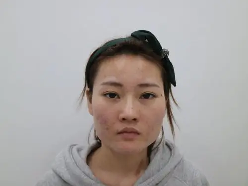 【取颊脂垫瘦脸】【v-line瓜子脸】改善宽脸方脸改脸型 30年临床经验