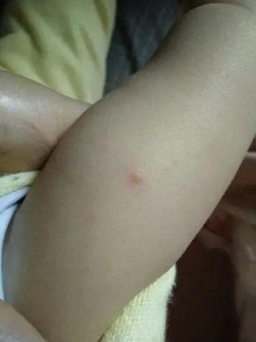 请问大家宝宝的手臂上长了几个这样的,没水泡.不知道是什么