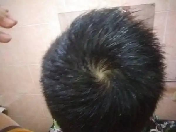 发旋长这样,会秃吗