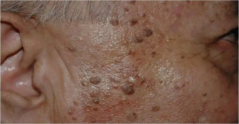 超惊人!老人斑通通消失了.竟然只要家里厨房就有的「这种水」!