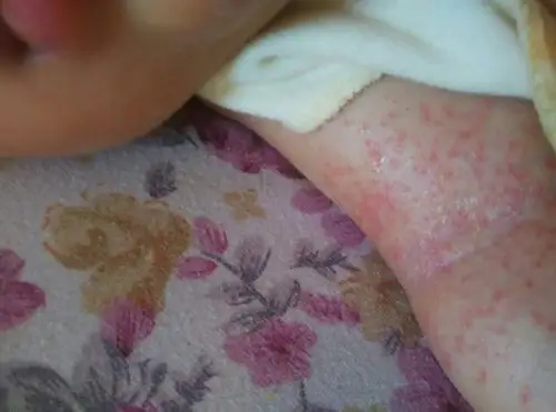 2016-08-01 11:50    浏览  33333  推荐回答 你好,应该是真菌感染