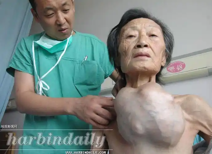 巨瘤胸前挂十年2小时卸包袱图