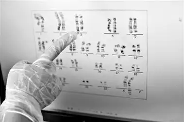河北邯郸发现罕见人类染色体异常核型 为世界首报
