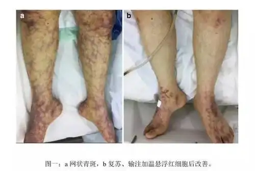 病例报道:不明原因休克