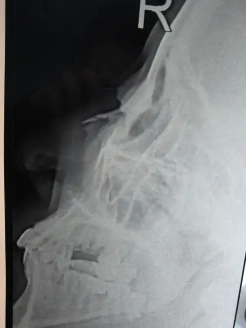 外伤致鼻骨骨折,颜面部皮肤软组织肿胀(附检查单,ct,x片).