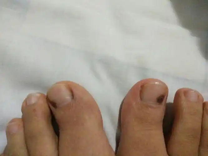我的母趾甲有黑点是怎么回事?