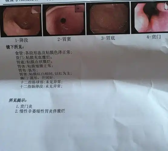 慢性非萎缩性胃炎伴糜烂很严重吗?