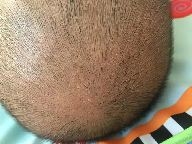 宝宝4个月10天出生十几天后头上一直有白色类似于头皮屑状皮