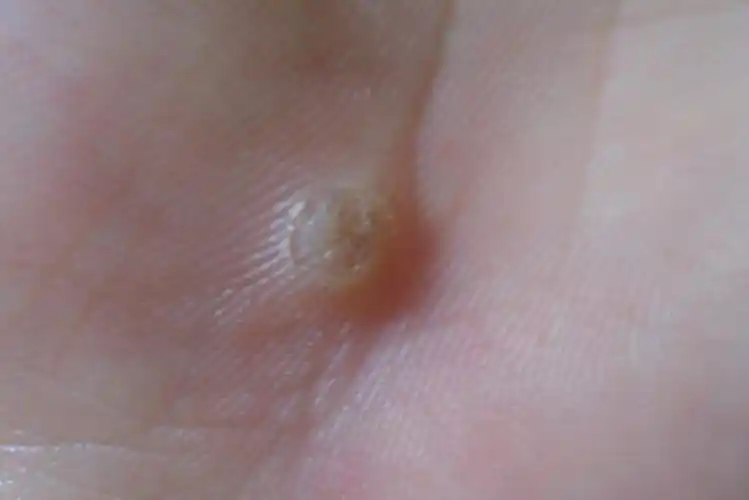 肚脐眼里长出疣状物 图片