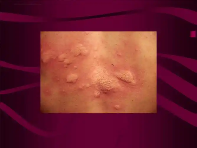 皮肤性病学教学荨麻疹ppt课件.ppt