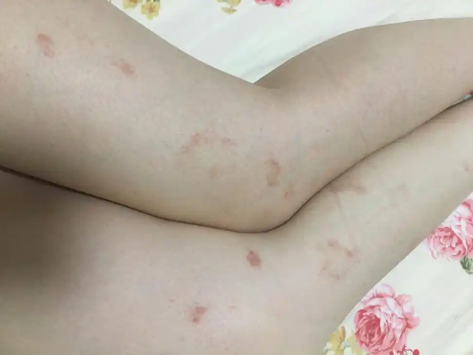 不知道怎么了,就起了一堆,一两个月了.也没怎么消,消的不如长的多